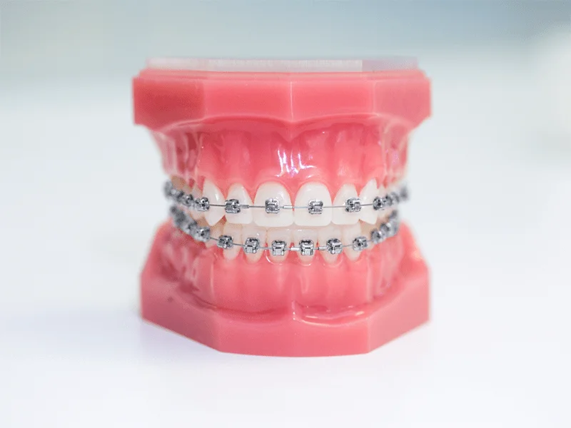 Mắc cài kim loại mặt ngoài