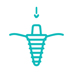 quy trình chồng răng Implant: bước 3