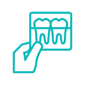 quy trình chồng răng Implant: bước 2